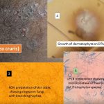 Dermatophyte-Introduction, lab diagnosis ans treatment