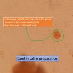 Entamoeba coli in saline preparation of stool