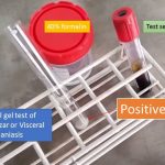 Formal gel test of Visceral leishmaniasis