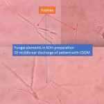 Fungal elements in KOH preparation