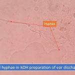 Fungal hyphae in KOH preparation of ear discharge
