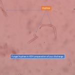 Fungal hyphae in KOH preparation of pus discharge