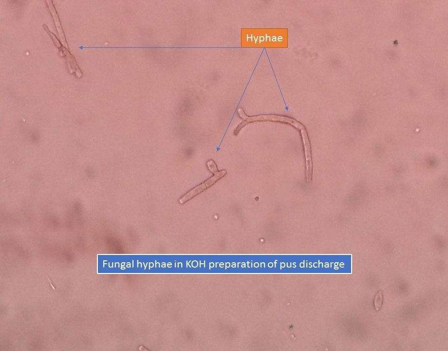 Fungal hyphae in KOH preparation of pus discharge