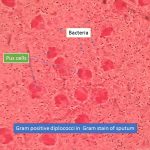 Gram positive diplococci in Gram stain of sputum