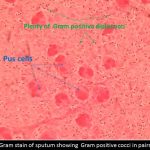 Gram stain of sputum showing Gram positive cocci in pairs