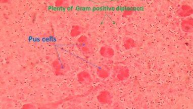 Gram stain of sputum showing Gram positive cocci in pairs