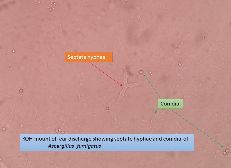 KOH mount of ear discharge showing septate hyphae and conidia of Aspergillus fumigatus