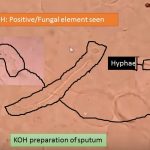 KOH preparation of sputum showing fungal elements