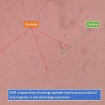 KOH preparation showing septate hypha and conidia of Aspergillus fumigatus in ear discharge