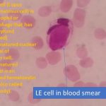 LE cell in blood smear