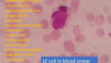 LE cell in blood smear
