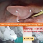 Liver fluke
