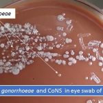Neisseria gonorrhoeae and Cons in eye swab of neonate