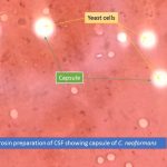 Nigrosin preparation of CSF showing capsule of Cryptococcus neoformans