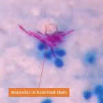 Nocardia in Acid fast stain