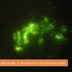 Nocardia in Auramine rhodamine stain