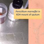 Penicillium marneffei in KOH mount of sputum