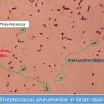 Pneumococcus in gram stain showing gram positive diplococci