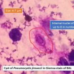 Pneumocystis jirovecii in Giemsa stain