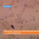 Reticulocytes in blood smear