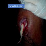 fungal infection site