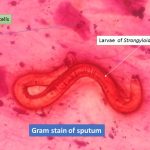 Strongyloides in gram stain of sputum