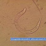 Strongyloides stercoralis in saline wet mount of stool