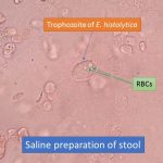 Trophozoites of Entamoeba histolytica in saline preparation of stool