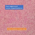 Vibrio cholerae in Gram stain showing gram negative bacteria and comma shape
