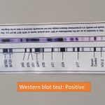 Western blot test positive