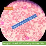 Wright stained PBS showing eosinophilia