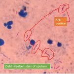 Ziehl -Neelsen stain of sputum