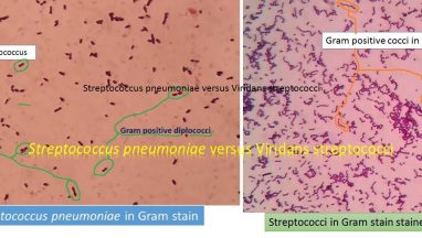 Streptococcus pneumoniae versus Viridans streptococci