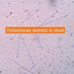 Trichomonas hominis under microscope of stool sample