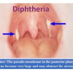 Diphtheria introduction, pathogenesis ,lab diagnosis and treatment