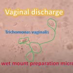 Trichomoniasis causing Trichomonas in saline wet mount preparation