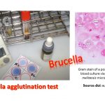 Brucella -Major-General Sir David Bruce, in  1886 isolated  Brucella from a spleen of the fatal case, in Malta and the disease called brucellosis. Brucellosis is essentially an infection of animal ( zoonotic disease) mainly of domestic animals, caused by genus Brucella. The other names of brucellosis include (human /animal disease)- Malta fever/Bang's disease Mediterranean fever/epizootic abortion Undulant fever/enzootic abortion Rock fever of Gibraltar/slinking of calves Contagious abortion/spontaneous abortion Gastric fever/ram epididymitis