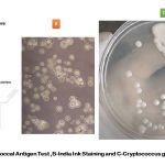 Cryptococcal Antigen Test: Introduction, Principle, Test Procedure, Result Interpretation and Clinical Significance