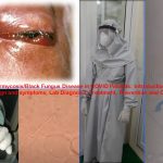 Mucormycosis/Black Fungus Disease in COVID Patients: Introduction, Causative agent, Sign and symptoms, Lab Diagnosis, Treatment, Prevention and Control