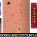 Mycobacterium leprae: Introduction, Morphology, Pathogenicity, Lab Diagnosis, Treatment and Prevention