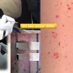 Slit Skin Smear (SSS): Introduction, Preparation, Staining, Result Interpretation, Application and Keynotes