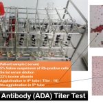 Anti D Antibody (ADA) Titer Test: Introduction, Principle, Procedure, Result Interpretation and Keynotes