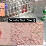 Coomb Test: Introduction, Types, Procedure, Result Interpretation and Clinical Significance