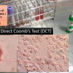 Direct Coomb Test (DCT)-Introduction, Principle, Procedure, Result Interpretation,Clinical Significance and Keynotes