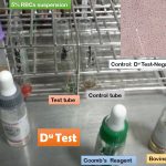 Du Test: Introduction, Principle, Procedure, Result Interpretation and Clinical Significance