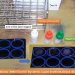 Antinuclear Antibody (ANA)Test: Introduction, Principle, Procedure, Result Interpretation, Clinical Significance and Keynotes