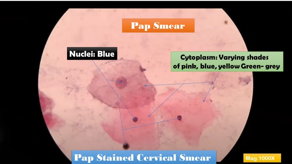 Pap Stain-Introduction, Principle, Staining Procedure, Result Interpretation and Keynote