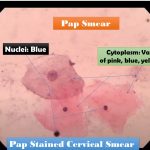 Pap Stain-Introduction, Principle, Staining Procedure, Result Interpretation and Keynote