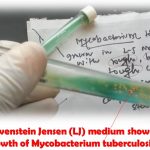Lowenstein Jensen Medium: Introduction, Coposition, Preparation, Procedure, Result Interpretation and Keynotes