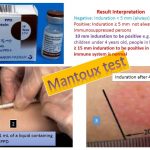 Tuberculin Test: Introduction, Procedure, Normal Range and Result Interpretation
